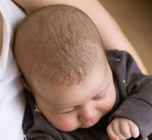 Mustela crema para la costra láctea